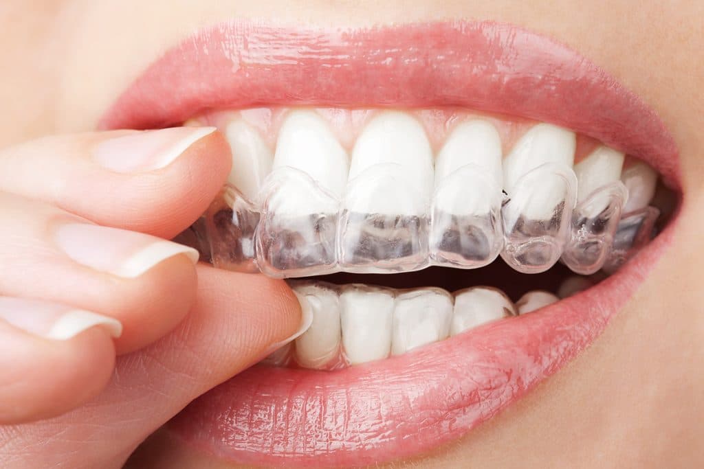 Can Invisalign Fix My Specific Dental Issue?