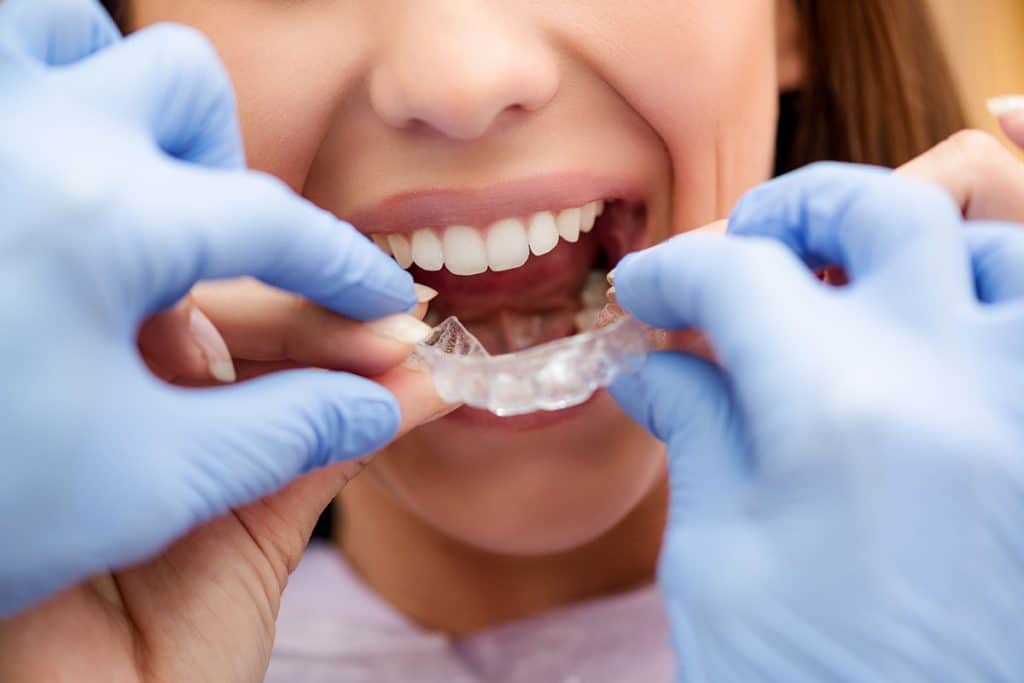 How Does Invisalign Work?